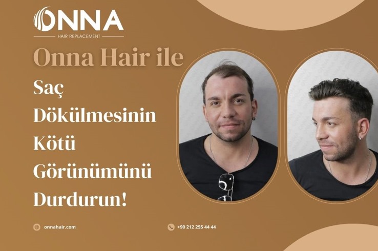 Onna Hair ile Saç Dökülmesinin Kötü Görünümünü Durdurun! 2 Protez Saç Uzun Ömürlü Kullanılır Mı?